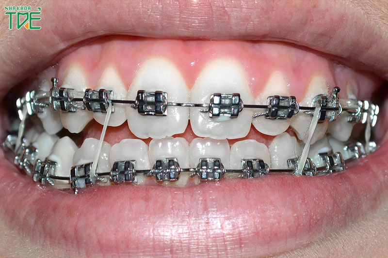 Niềng răng khớp cắn chéo đạt hiệu quả cao nếu lệch lạc do răng