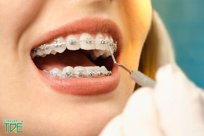 Niềng răng 2 hàm sẽ mang lại kết quả chỉnh nha tối ưu