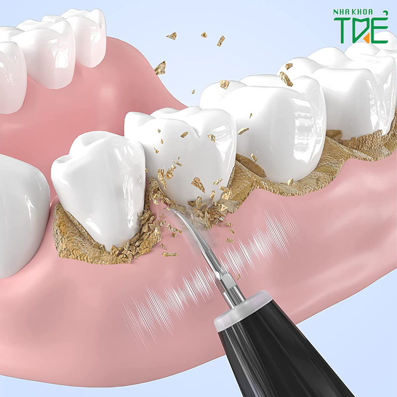 Quy trình lấy cao răng gồm mấy bước? Mất thời gian bao lâu?