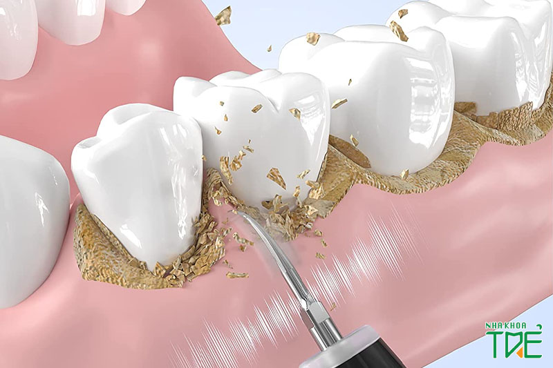 Quy trình lấy cao răng gồm mấy bước? Mất thời gian bao lâu?