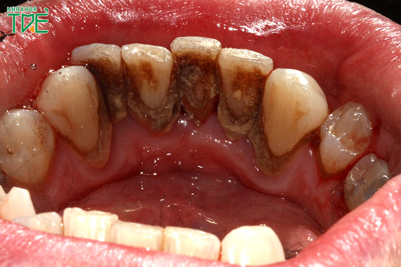 Cao răng cứng ở chân răng chứa rất nhiều vi khuẩn gây hại