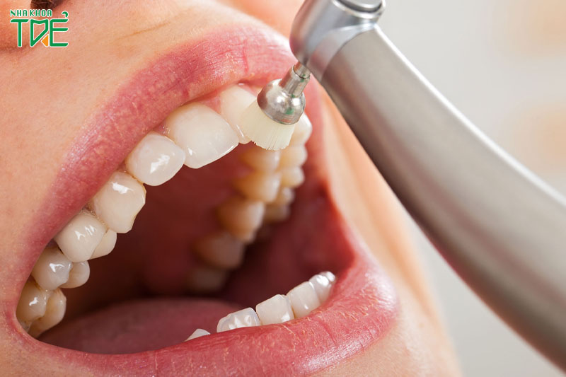 Đánh bóng răng để hoàn tất quá trình lấy cao răng 