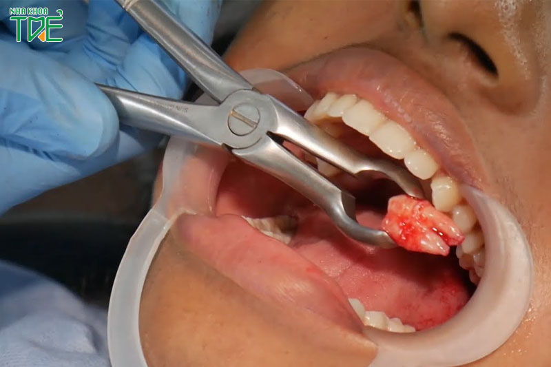 Quy trình nhổ răng khôn đạt chuẩn gồm mấy bước?