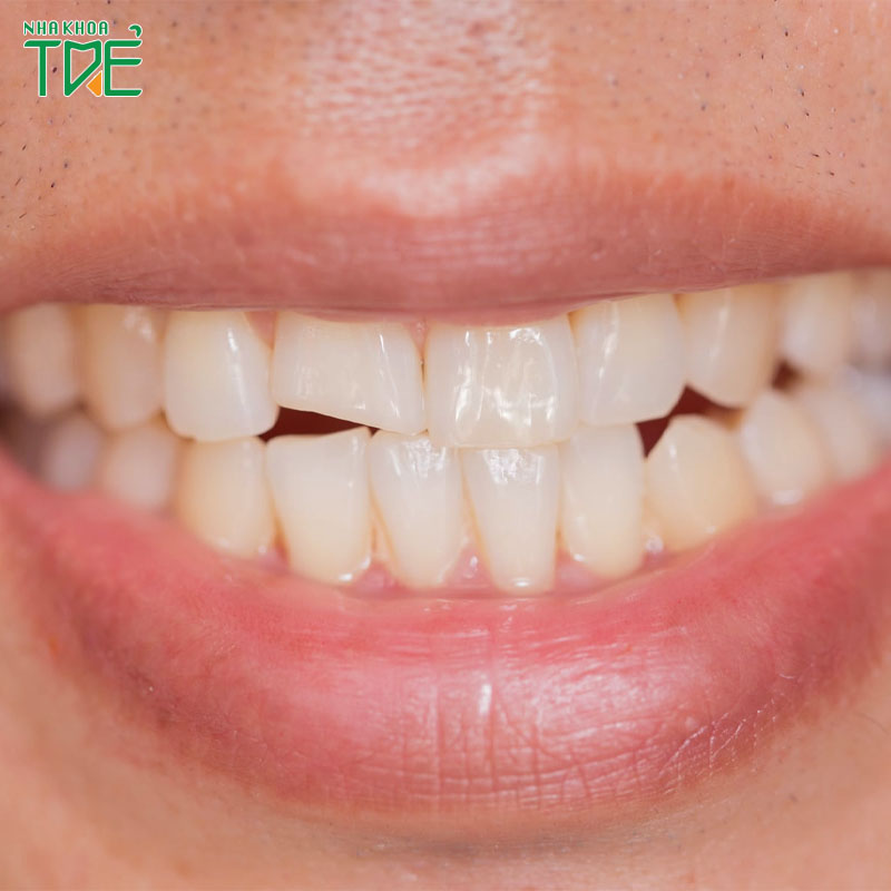 Răng bị mẻ có lành lại được không? Phải làm sao khắc phục răng bị mẻ?