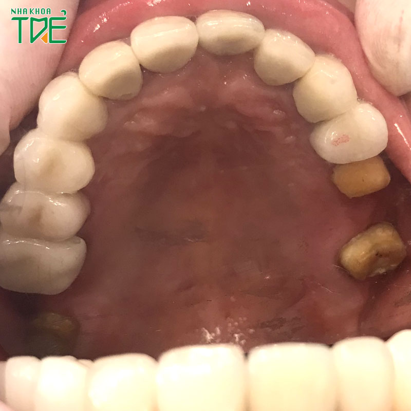 Răng cấm tự rụng: Hậu quả và giải pháp khắc phục tối ưu