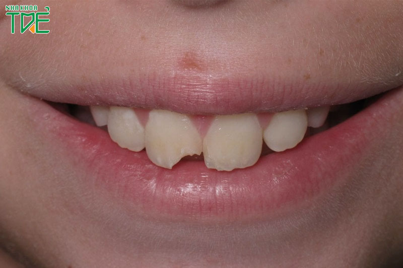 Răng cửa bị mẻ là khiếm khuyết lộ rõ trên khuôn mặt