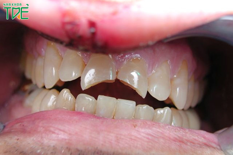 Răng cửa bị sứt mẻ gây ảnh hưởng xấu đến răng miệng