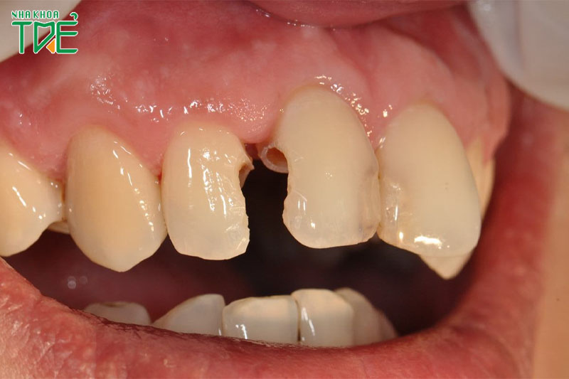 Răng cửa bị sâu là hiện tượng ăn mòn mô cứng của răng