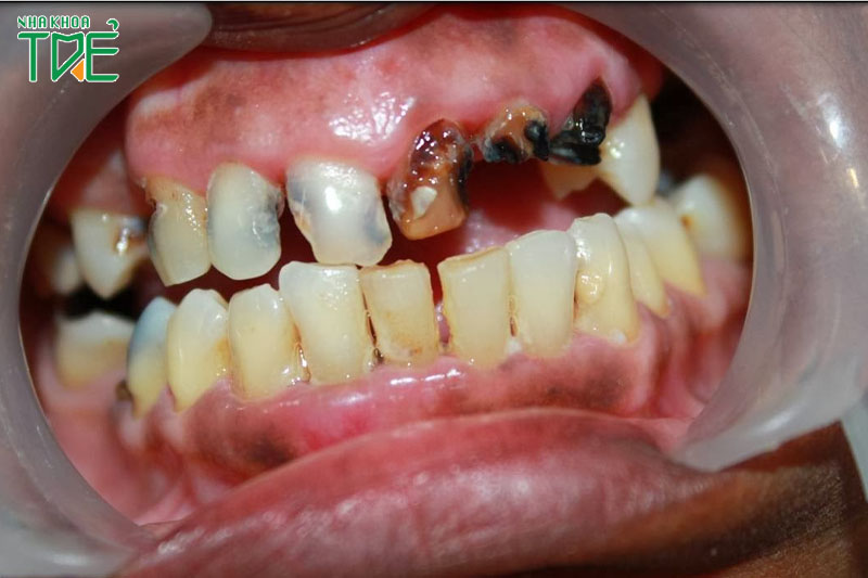 Răng sâu làm đổi màu răng, mất răng cửa làm giảm thẩm mỹ nghiêm trọng