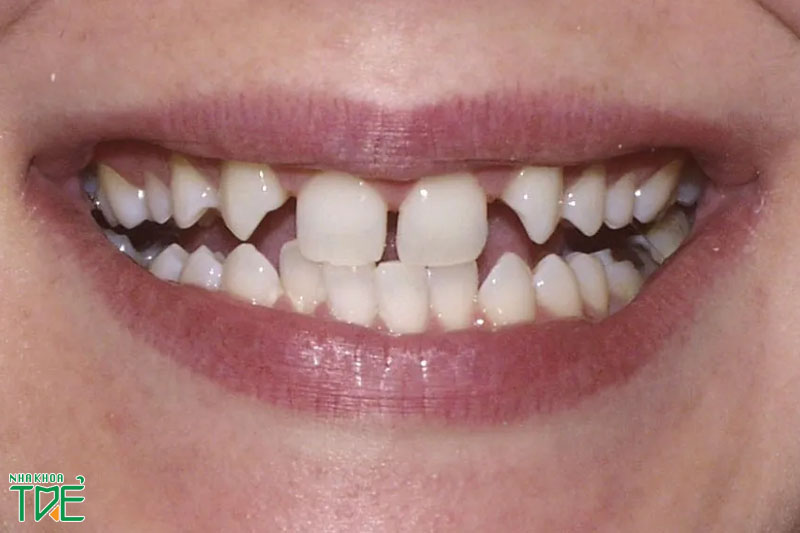 Răng thưa gây mất thẩm mỹ nên cần bọc sứ hoặc niềng răng để khắc phục