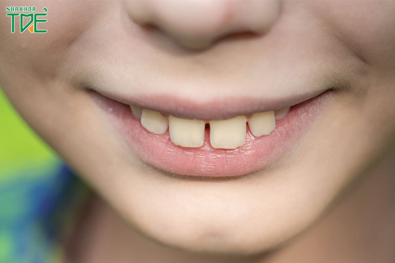 Răng hô có di truyền không? Cách điều trị như thế nào?