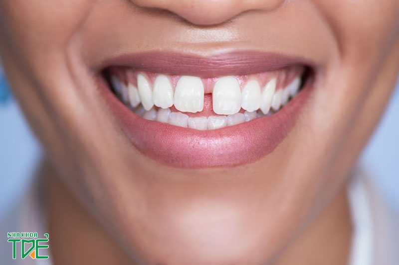Răng hở kẽ thường xuất hiện ở vị trí răng cửa
