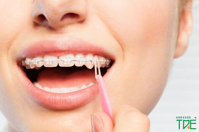 Niềng răng để dịch chuyển, sắp xếp các răng thẳng hàng, không còn kẽ hở