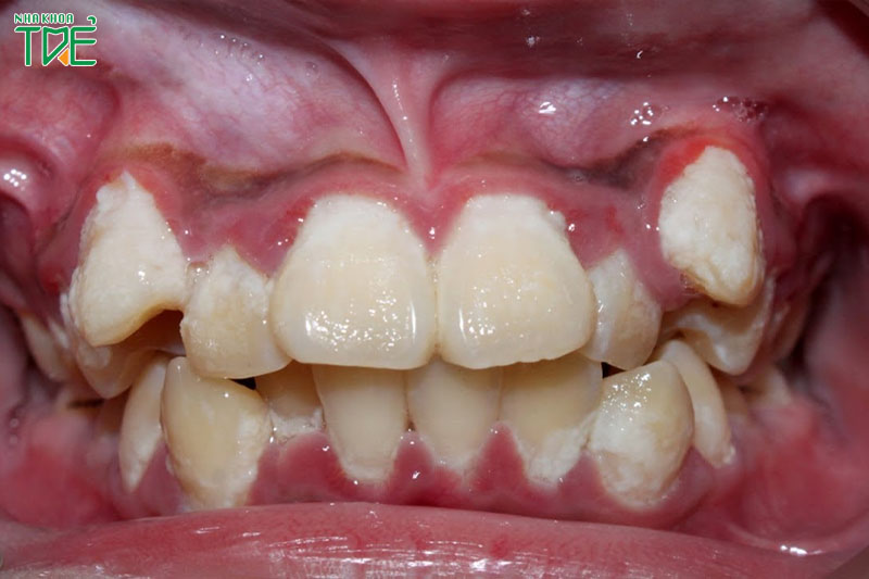 Răng khểnh gây ra nhiều vấn đề răng miệng