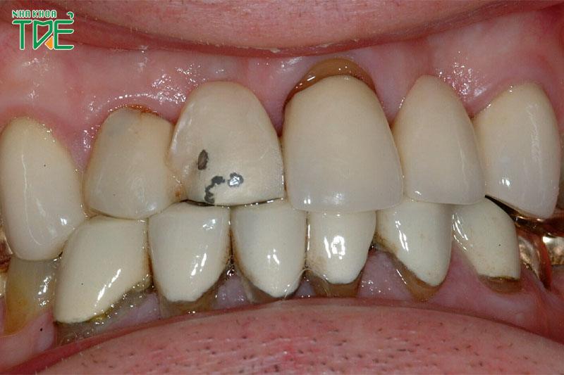 Răng sứ bị hỏng có thể do keo dán kém chất lượng