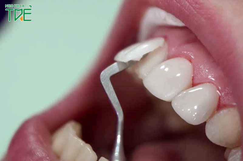 Răng sứ không vừa vặn sẽ khiến răng bị hư hỏng nhanh chóng