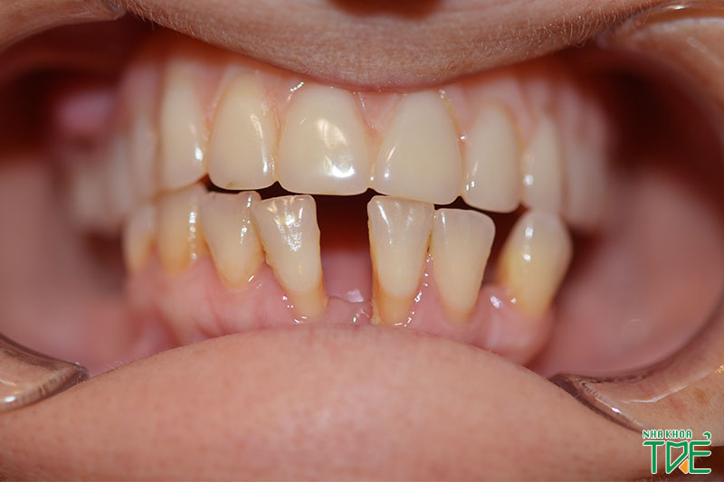 Răng hàm dưới bị thưa gây mất thẩm mỹ và suy giảm chức năng ăn nhai