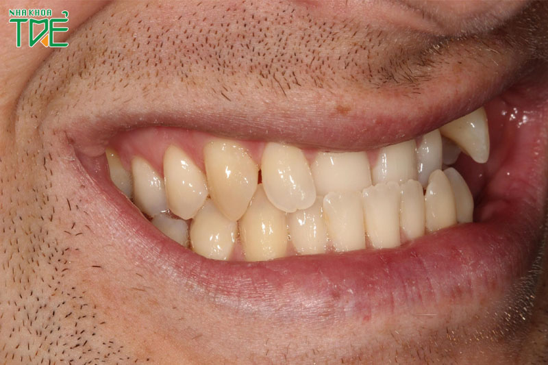 Sai khớp cắn loại 3 chính là tình trạng khớp cắn ngược, răng móm
