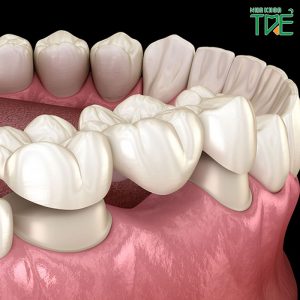 Sau mất răng có nên làm cầu răng số 4 không?