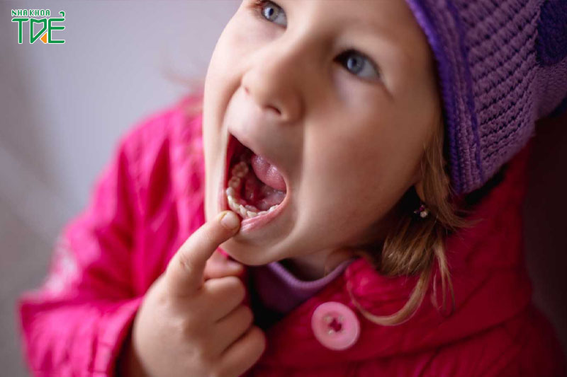 Đẩy lưỡi có thể hình thành ở trẻ nhỏ do mất răng sữa sớm