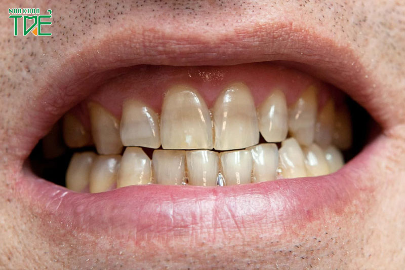 Răng nhiễm Tetracycline khó đáp ứng thuốc tẩy trắng răng