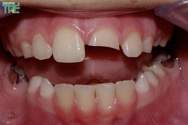 Răng cửa bị mẻ lớn không thể trám răng thẩm mỹ