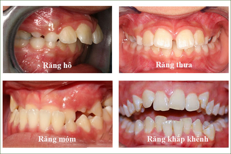 Các tình trạng sai lệch răng thường gặp ở trẻ em