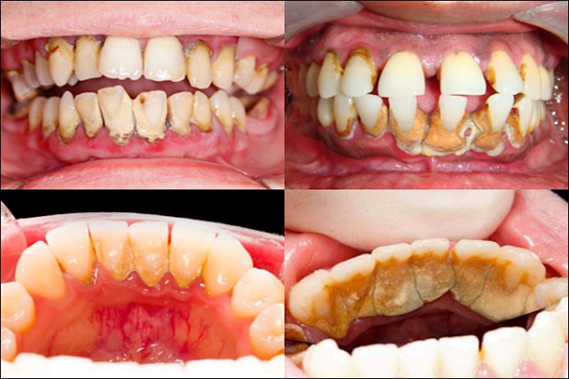 Răng thưa khiến mảng bám thức ăn dễ dàng bám và khó vệ sinh sạch