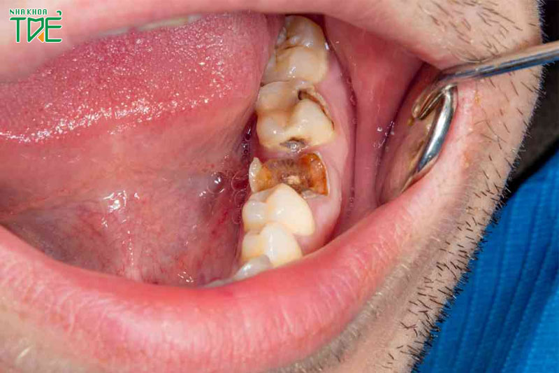 Sâu răng là bệnh lý răng miệng phổ biến nhất