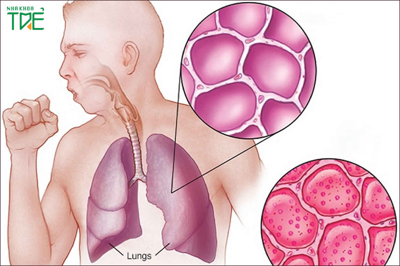 Viêm lợi làm tăng nguy cơ viêm phổi 