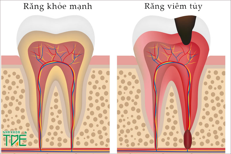 Viêm chóp quanh răng bắt nguồn từ viêm tủy răng