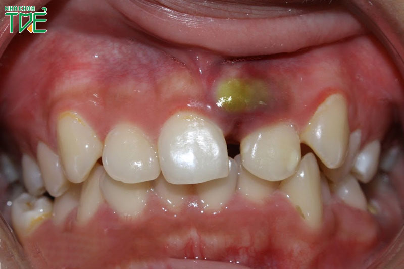 Viêm chóp răng có hiện tượng sưng mủ quanh răng