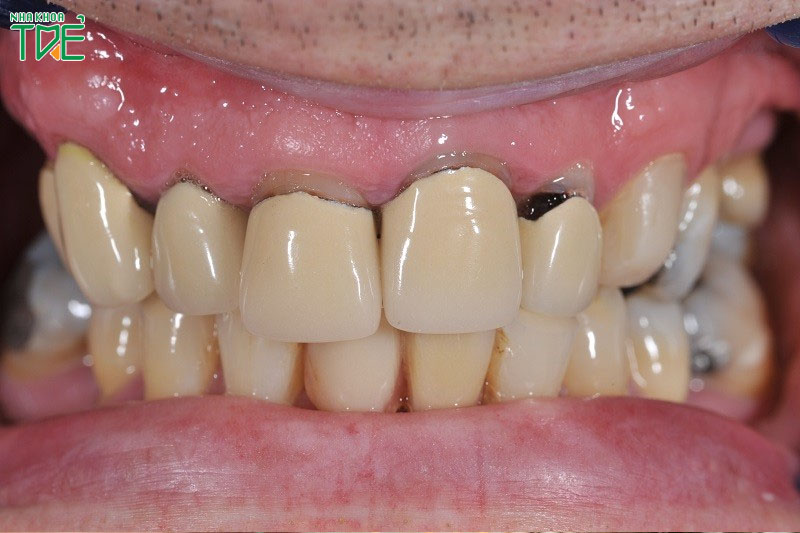 Răng sứ bị lỗi nên đến nha khoa để điều chỉnh lại