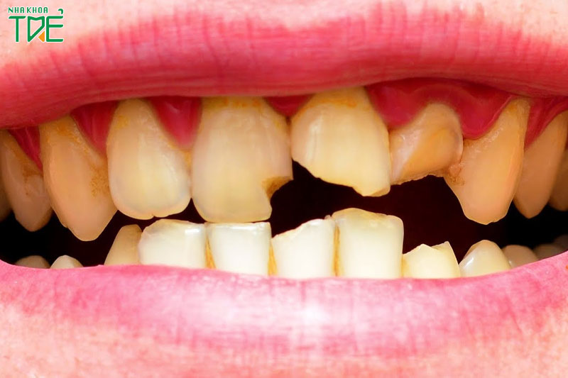 Bọc răng sứ để khắc phục tình trạng răng sứt mẻ, ố vàng