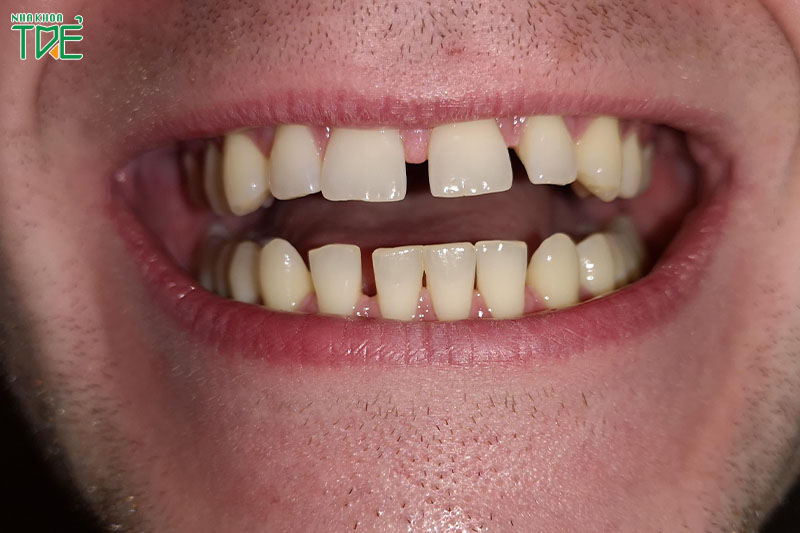 Răng thưa gây mất thẩm mỹ và răng bị suy yếu