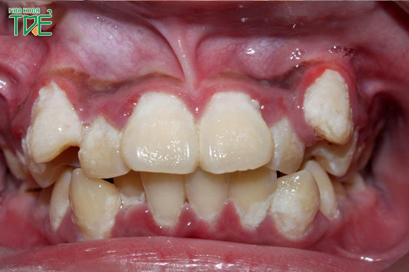 Răng khểnh quá mức vừa mất thẩm mỹ vừa tăng nguy cơ mắc bệnh răng miệng