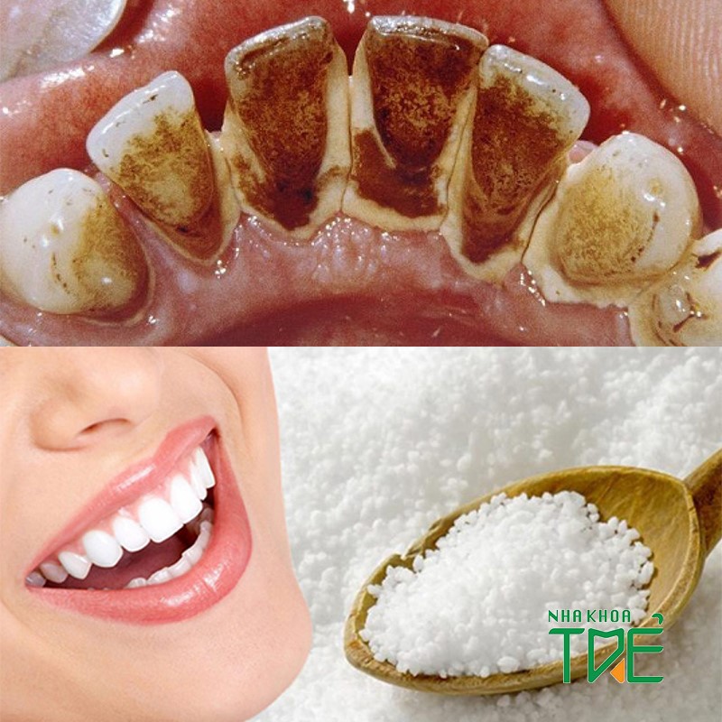 Top 3 cách lấy cao răng tại nhà bằng muối nhanh nhất