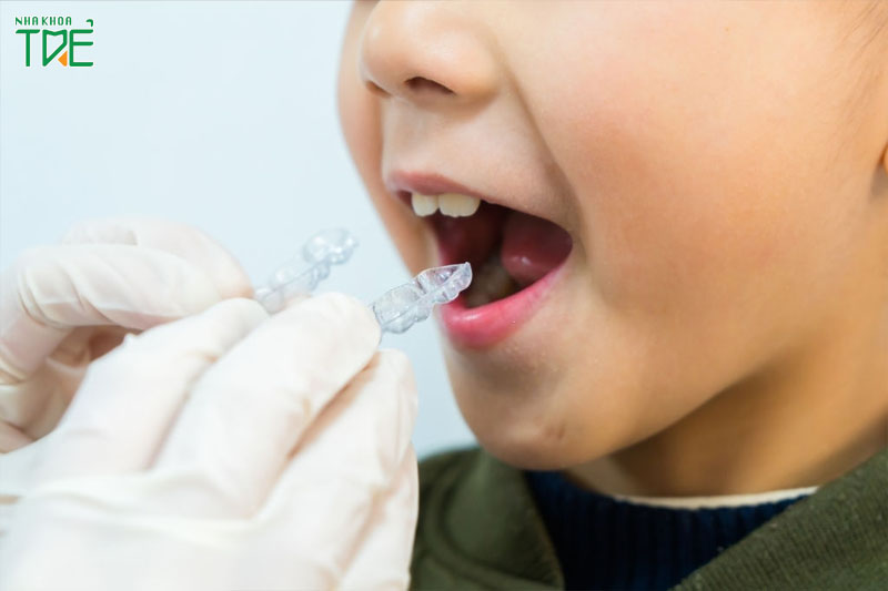Có thể niềng răng trong suốt cho trẻ ngay giai đoạn thay răng sữa