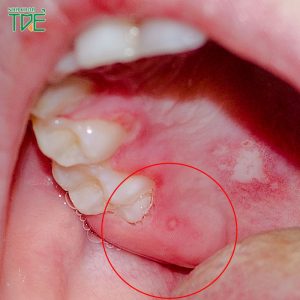 Cảnh báo dấu hiệu sưng lợi ở răng khôn và cách điều trị dứt điểm