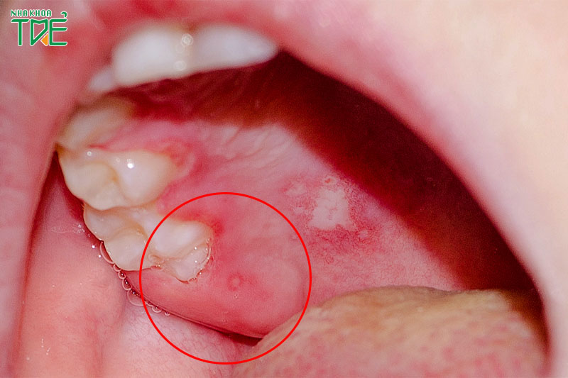 Cảnh báo dấu hiệu sưng lợi ở răng khôn và cách điều trị dứt điểm