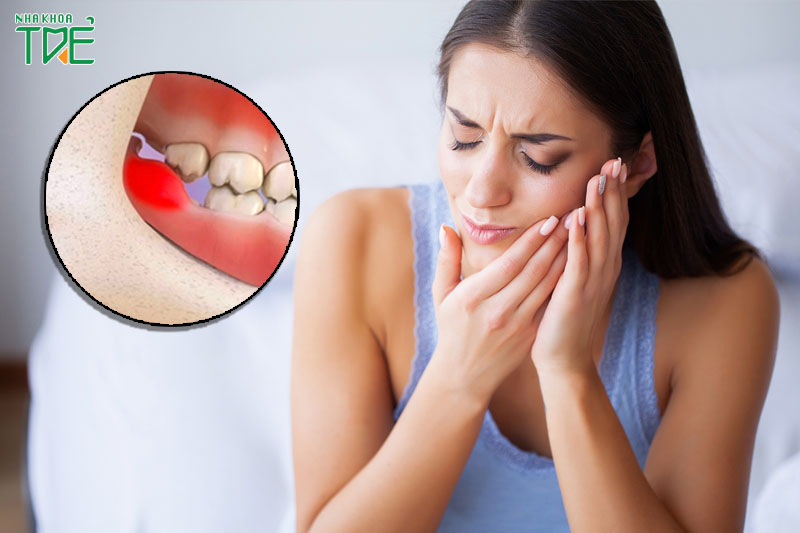 Triệu chứng đau nhức, sưng tấy lặp lại nhiều lần khi mọc răng khôn
