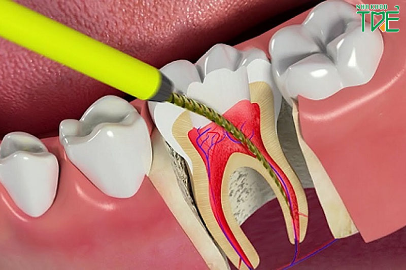 Lấy tủy răng để loại bỏ sạch mô viêm nhiễm
