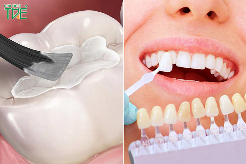 Trám răng và bọc răng sứ để phục hình răng sau chữa tủy