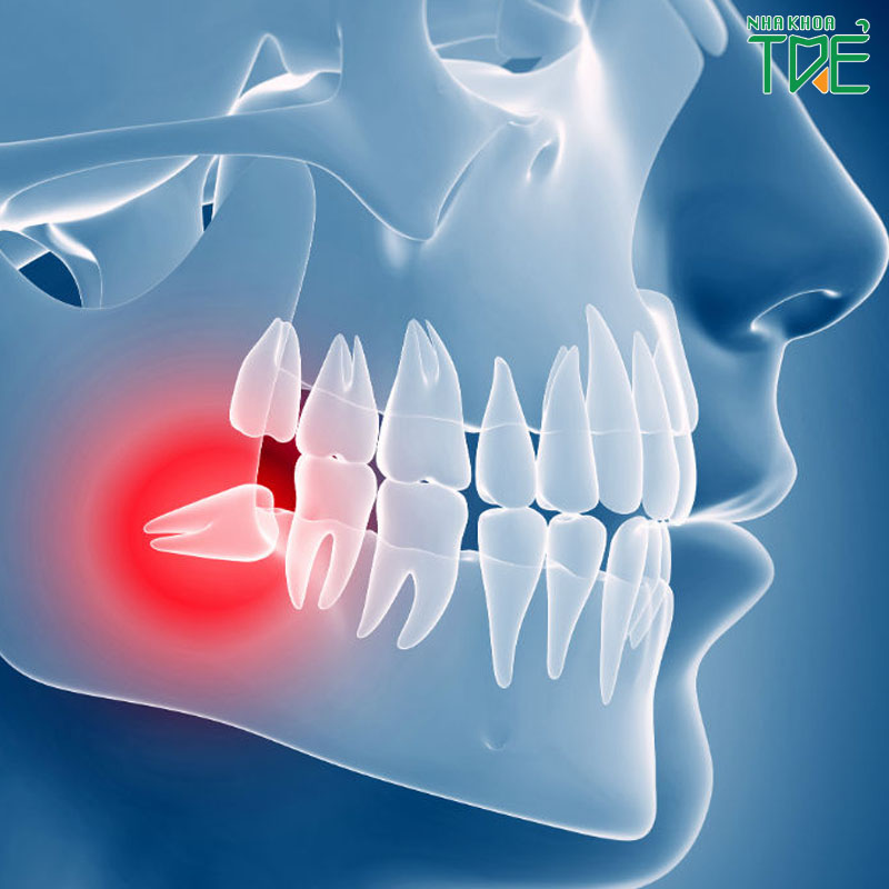 Nhổ răng khôn mọc lệch hàm dưới có nguy hiểm không?