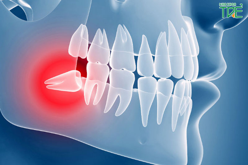Nhổ răng khôn mọc lệch hàm dưới có nguy hiểm không?