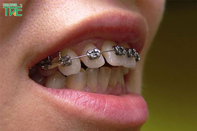Niềng răng bị chìa, răng hô vẩu - Giải pháp nào tốt nhất?