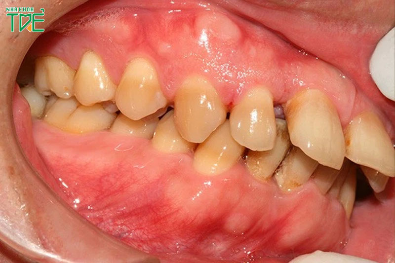 Răng bị chìa làm mất thẩm mỹ, suy giảm chức năng ăn nhai