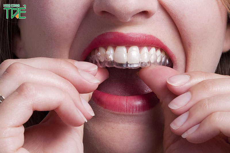 Niềng răng Invisalign có thể tự thay khay niềng tại nhà nên tiết kiệm được thời gian thăm khám