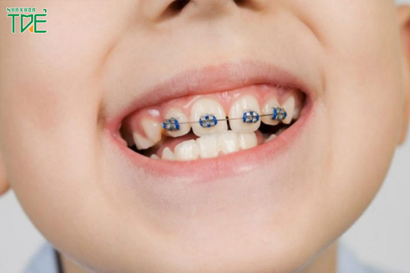 Niềng răng sớm cho trẻ mang lại nhiều lợi ích cho sức khỏe