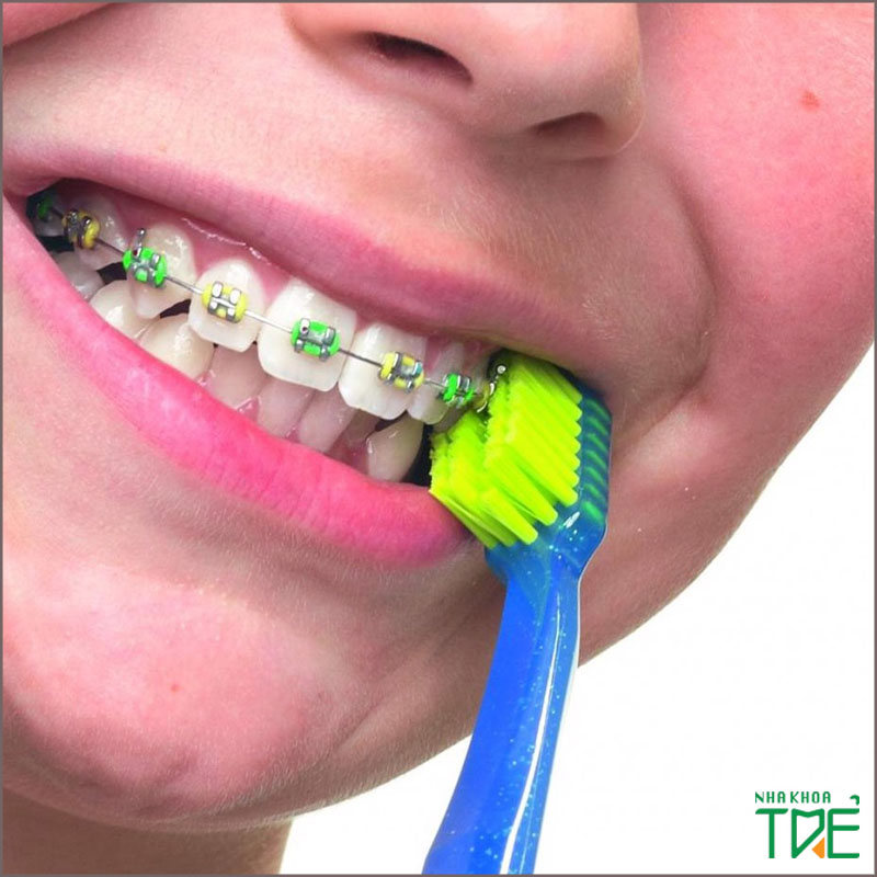 Niềng răng dùng bàn chải gì để vệ sinh răng miệng hiệu quả?